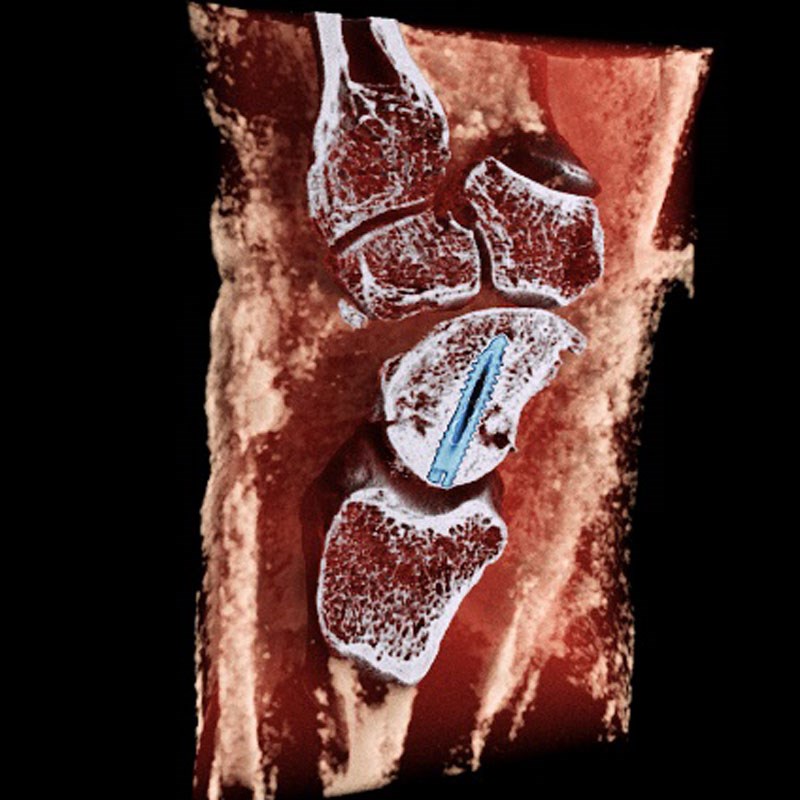 Detailed CT scan of a patient's wrist, showcasing the bones, muscles and a metal screw implant.